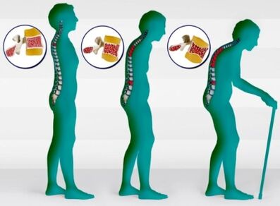 Osteoporóza